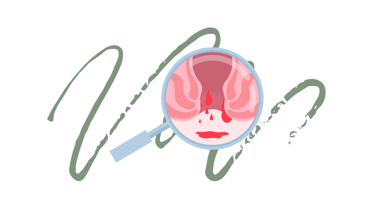 Emorroidi